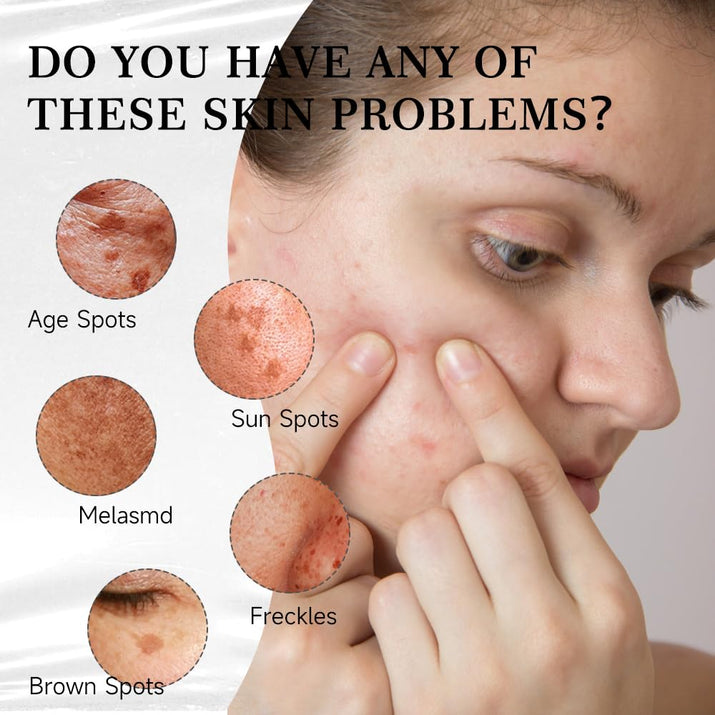 aobenz Dark Spot Remover for Face & Body | Advanced Corrector Serum for Age, Melasma, Sun, Acne, Black Spots | Tranexamic Acid, Niacinamide Formula for Women & Men | Mild, 1.35 Fl Oz (1PCS)